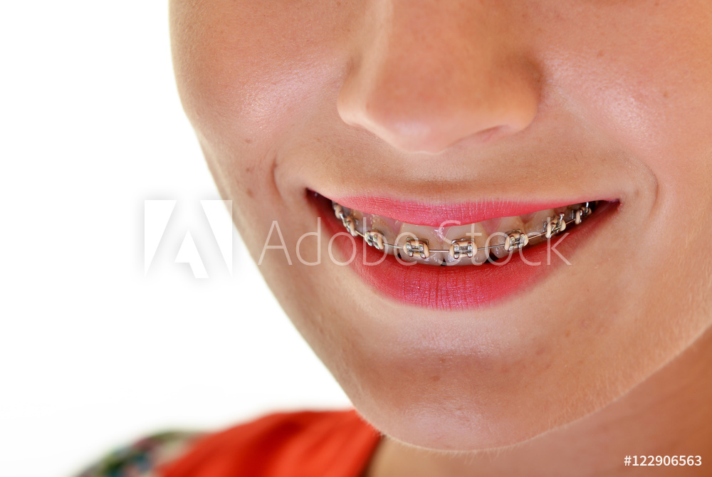 Brackets autoligados en Clínica Dental Roca Santiago en Fuengirola Málaga