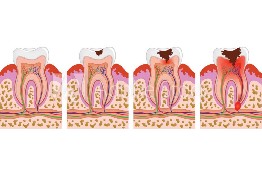 evolucion caries-01 - Clínica Dental Roca Santiago