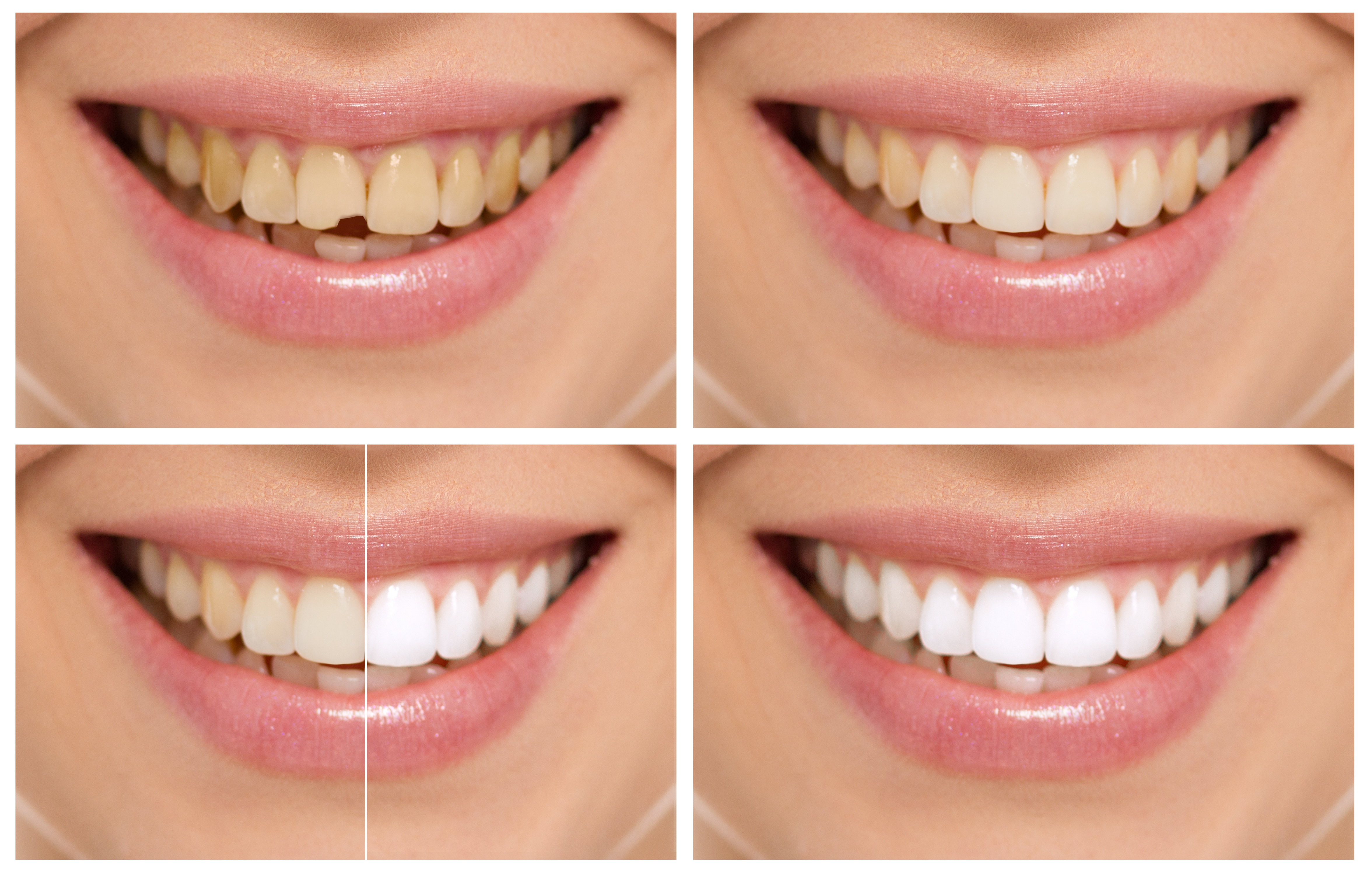 Tooth whitening at Roca Santiago Dental Clinic Fuengirola - Málaga