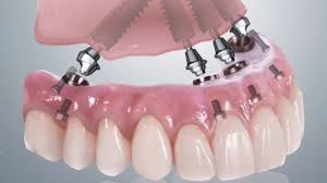implants with immediate loading / aesthetics at Clínica Dental Roca Santiago - Fuengirola