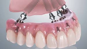 Carga Estética Inmediata - Clínica Dental Roca Santiago