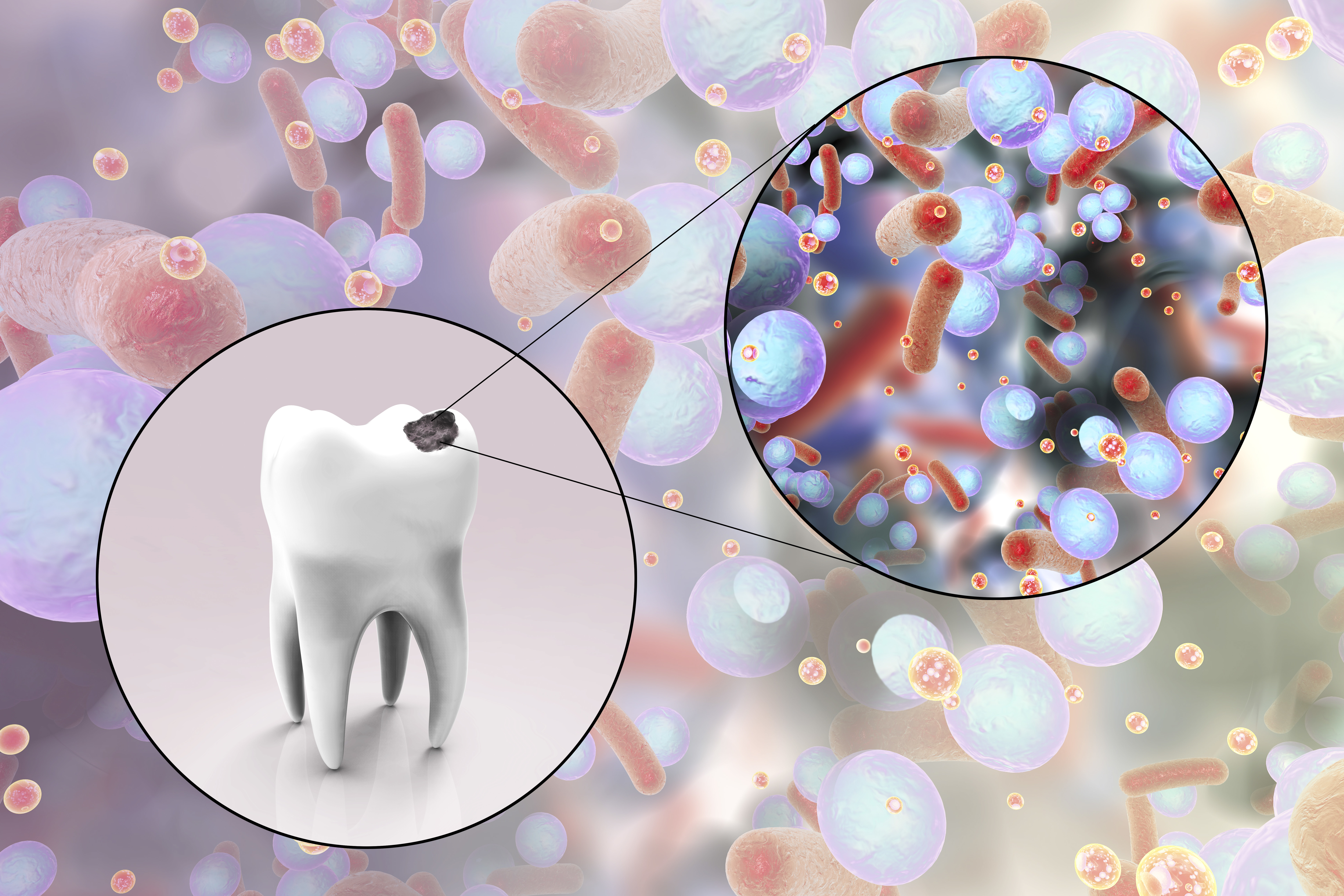 Cavities, the solution at Roca Santiago Dental Clinic