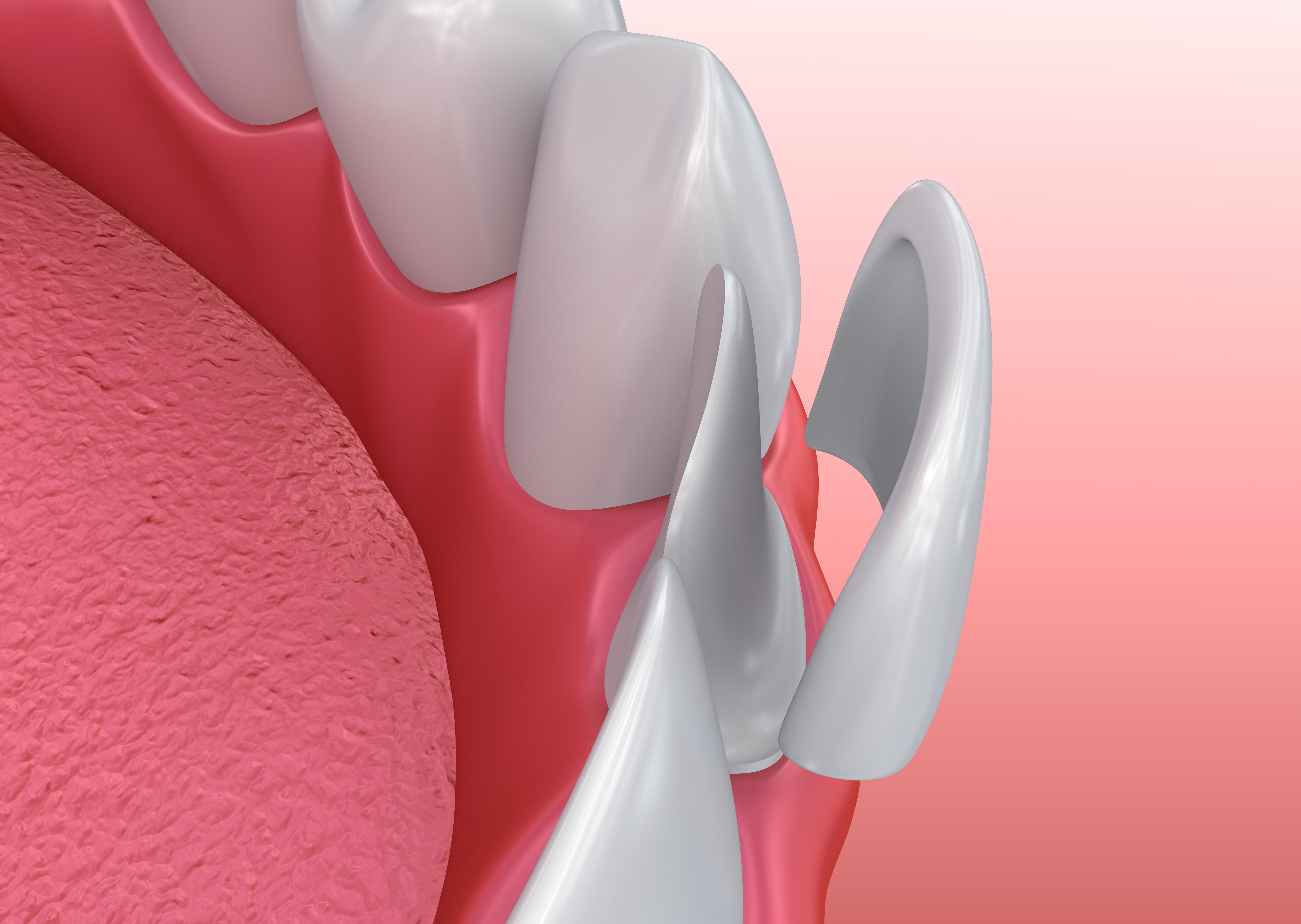 Dental Veneers at Clínica Dental Roca Santiago in Fuengirola