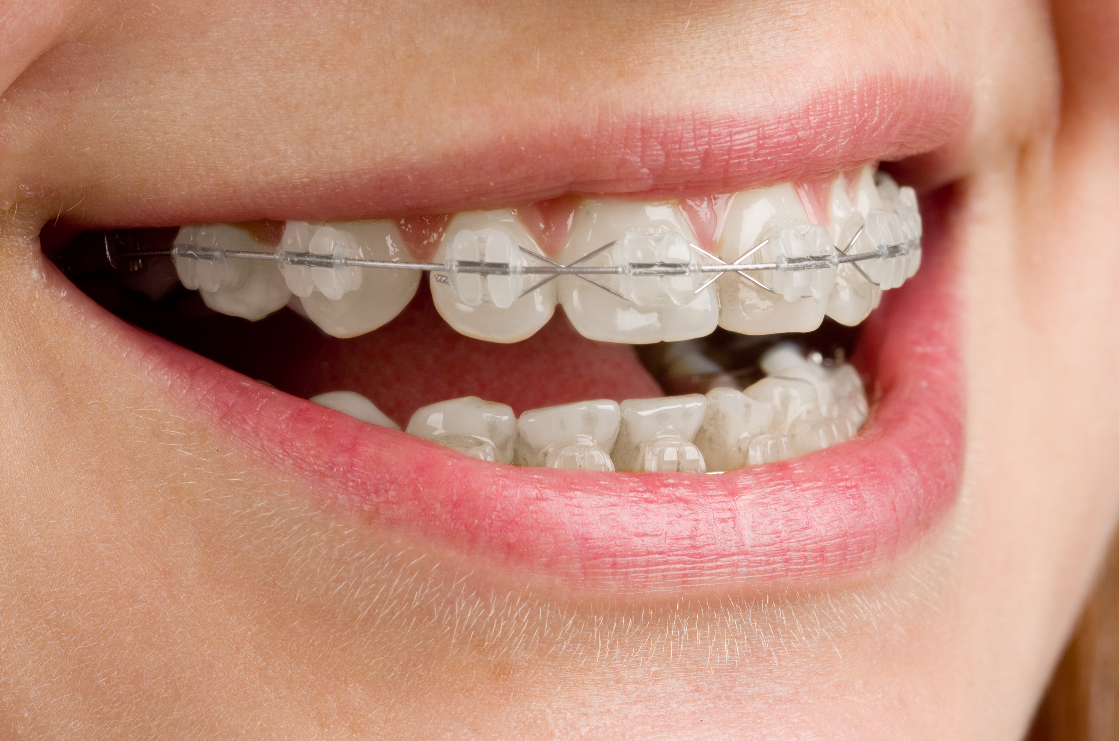 ortodoncia brackets estéticos en Clínica Dental Roca Santiago en Fuengirola, Málaga