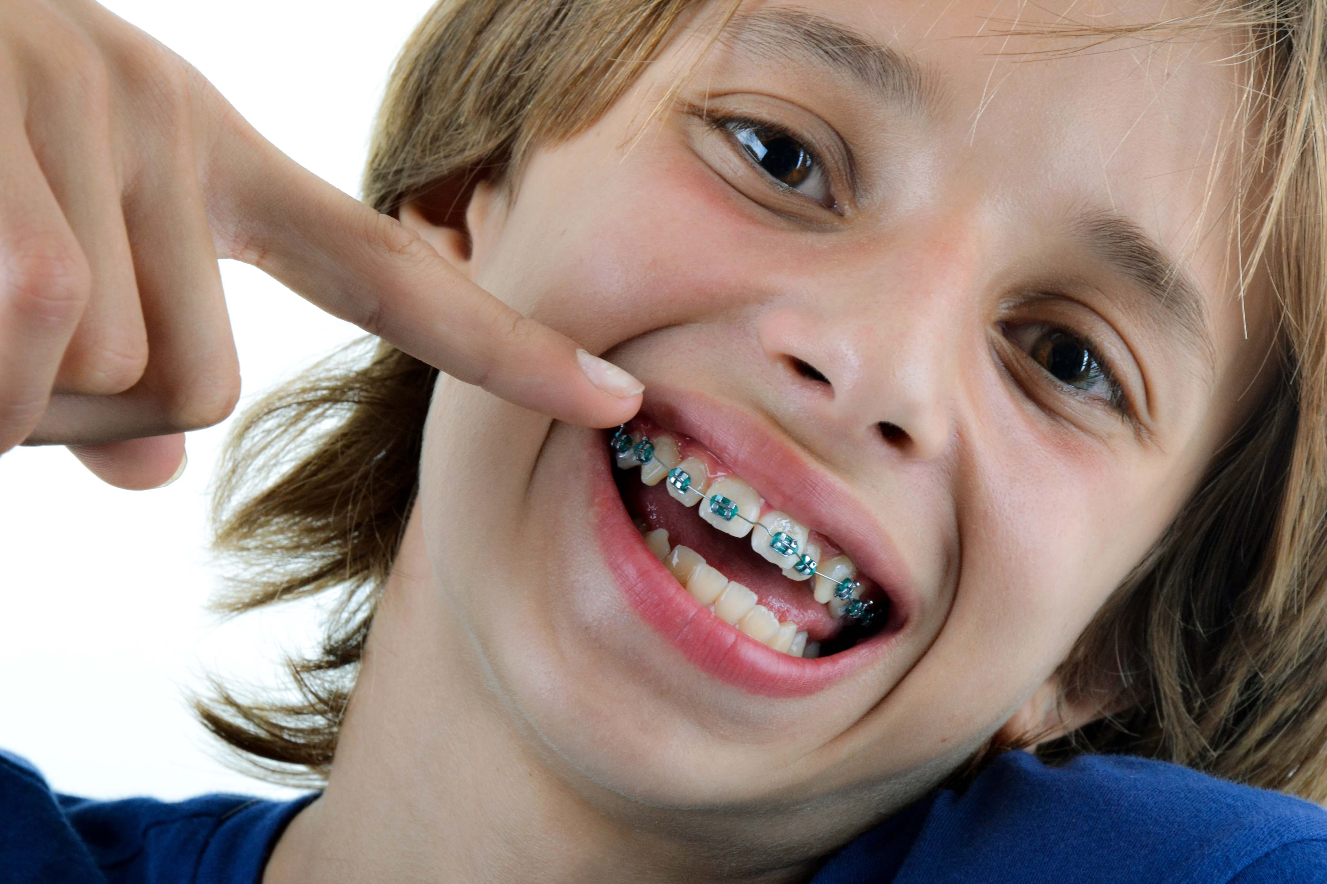 BRACKETS INFANTIL EN CLÍNICA DENTAL ROCA SANTIAGO EN FUENGIROLA - MÁLAGA BRACKETS INFANTIL EN CLÍNICA DENTAL ROCA SANTIAGO EN FUENGIROLA - MÁLAGA