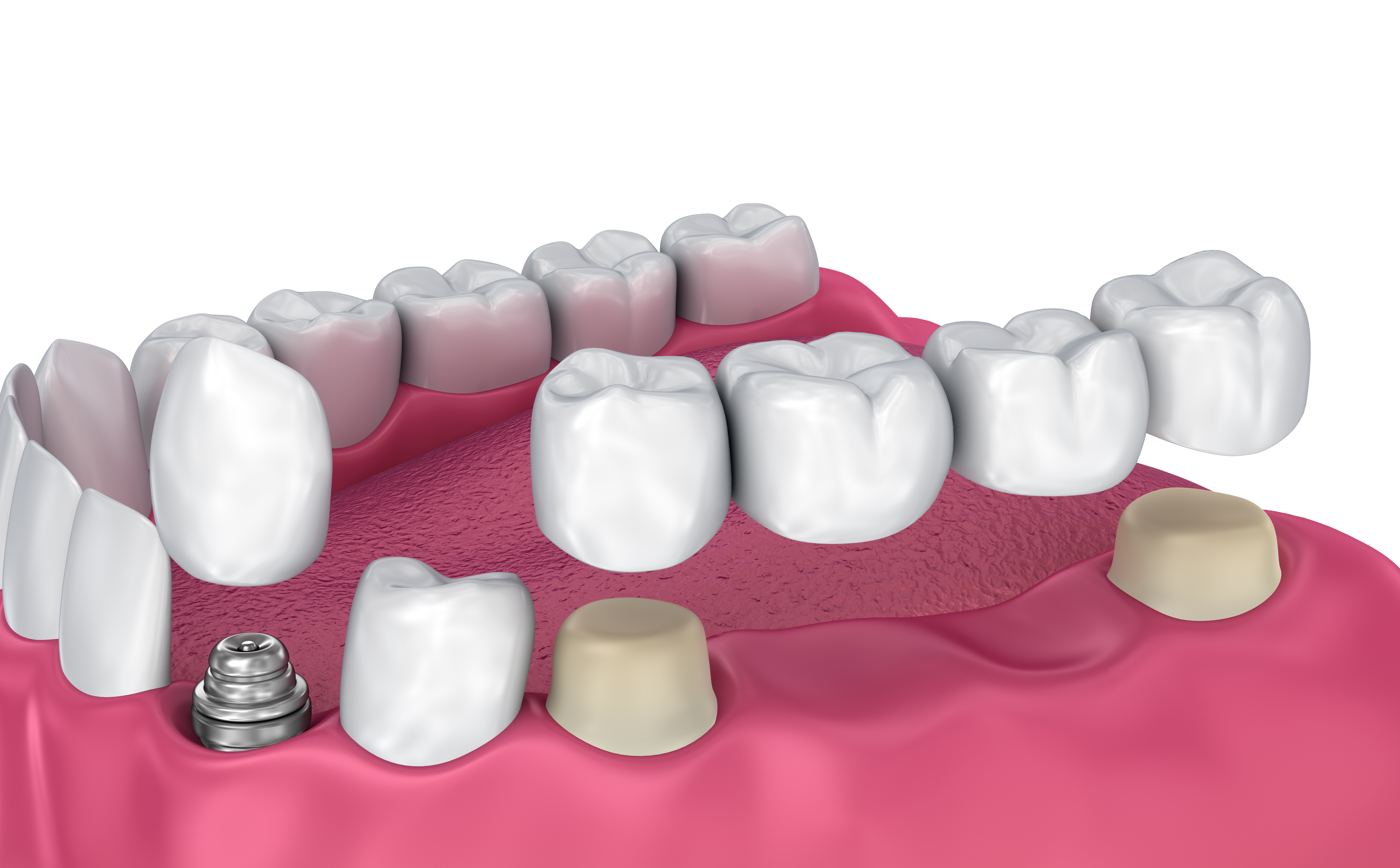 Dentures at Roca Santiago Dental Clinic - Fuengirola - Málaga