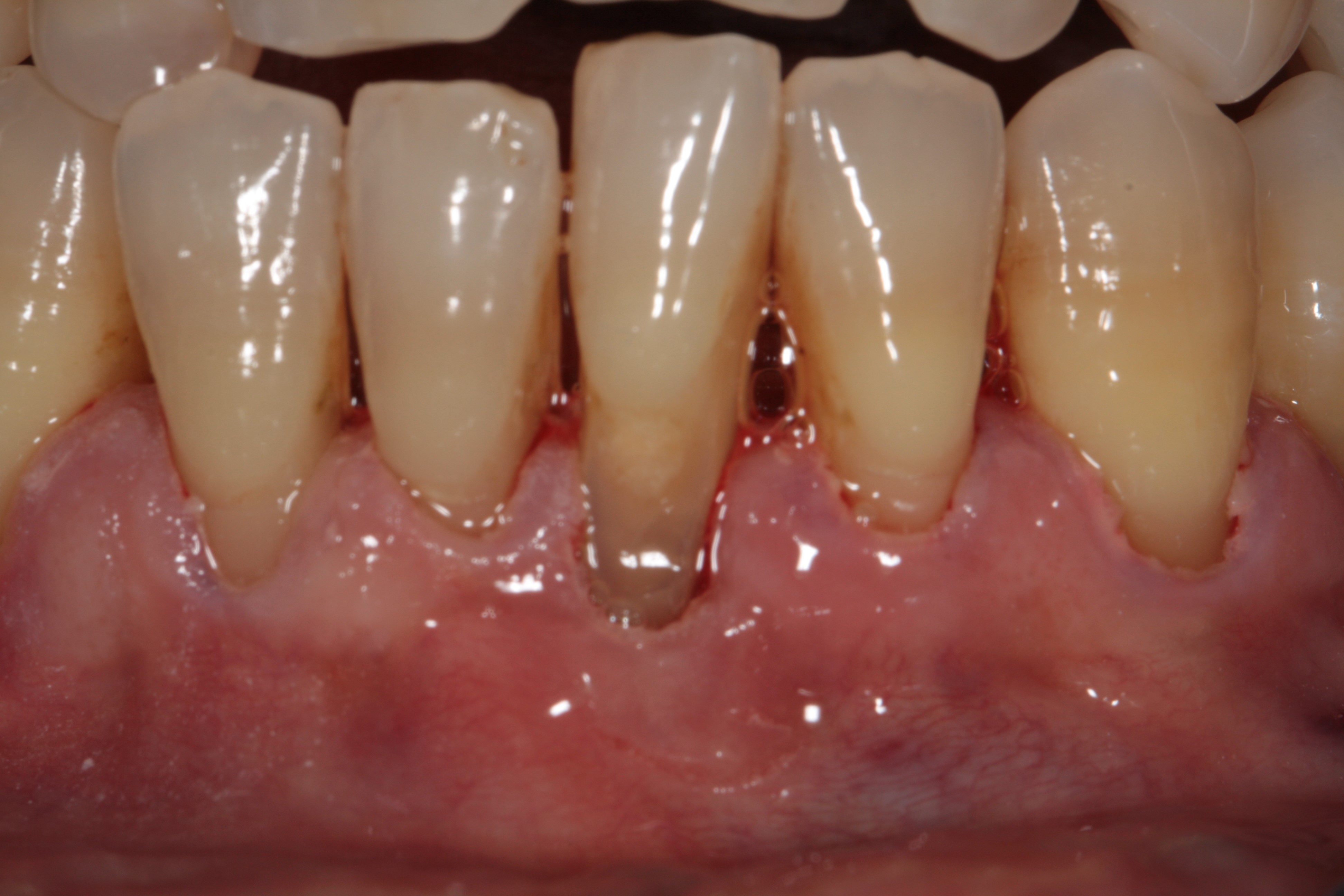 Mucogingival Surgery at Clínica Dental Roca Santiago - Fuengirola