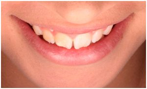 Dental Veneers - Clínica Dental Roca Santiago Fuengirola