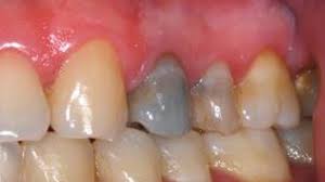 Carillas dentales- Diente endodonciado- Clínica Dental Roca Santiago Fuengirola