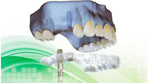 guided surgery - Clínica Dental Roca Santiago - Fuengirola