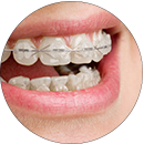 ORTHODONTICS WITH AESTHETIC BRACKETS IN CLÍNICA DENTAL ROCA SANTIAGO FUENGIROLA