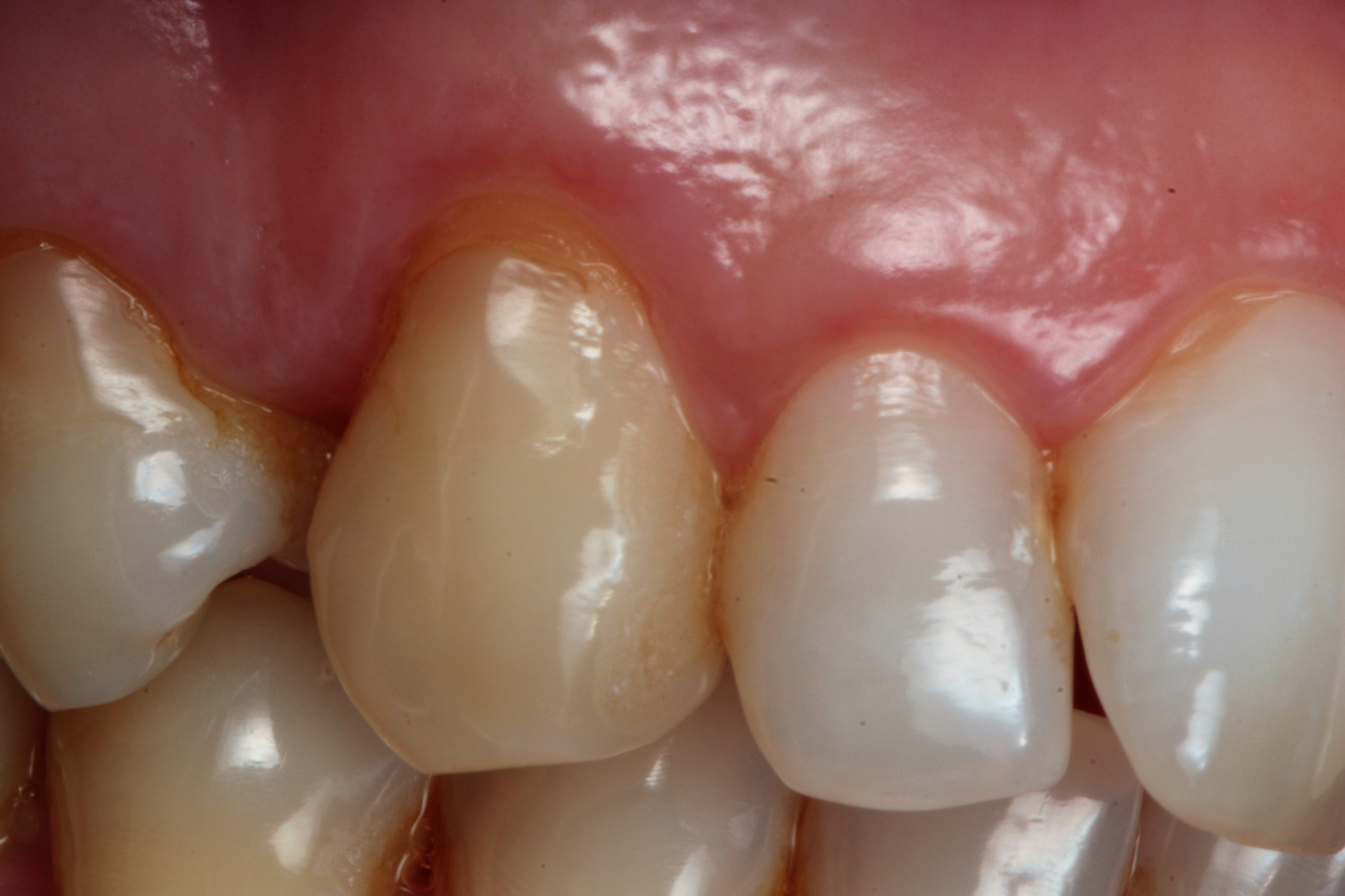 Mucogingival Surgery at Clínica Dental Roca Santiago - Fuengirola